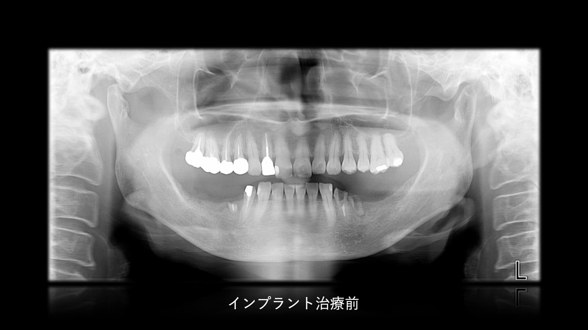 下顎奥歯のインプラント治療前